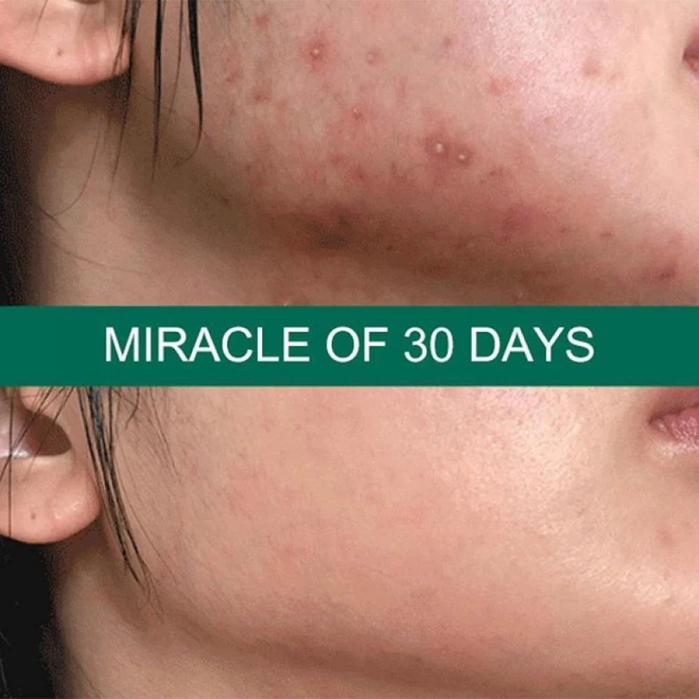 SOME BY MI 30Days Miracle Tea Tree Clear Spot Oil  - 10ml